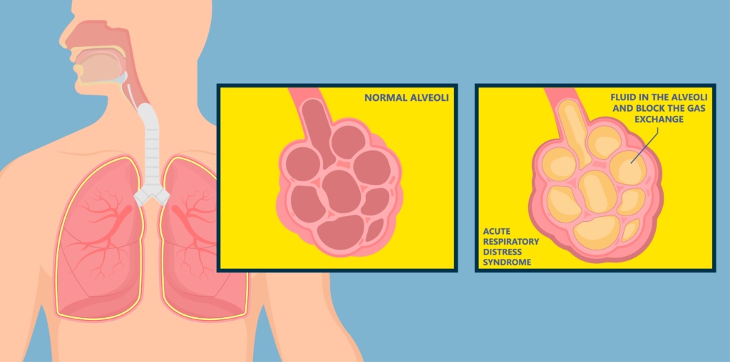 Illustration of pathology of Acute Respiratory Distress Syndrome (ARDS) - Echelon Biosciences